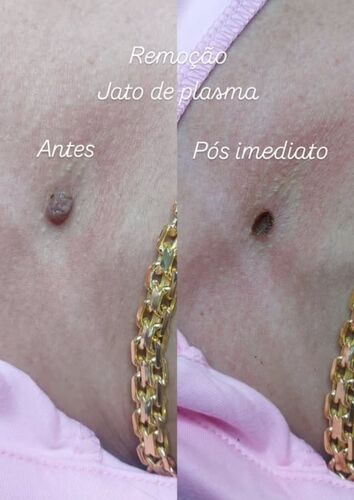 Antes e depois
